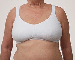 solution for uneven breast after breast conserving surgery – lumpectomy prosthesis by Amoena