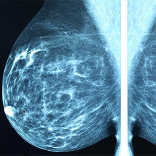 Demystifying the Mammogram Controversy
