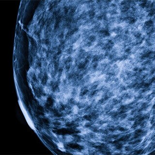 Mammograms detect fewer tumors among cancer survivors