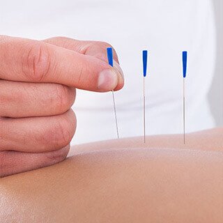Acupuncture Works as Well as Medication for Hot Flashes, Without the Side Effects