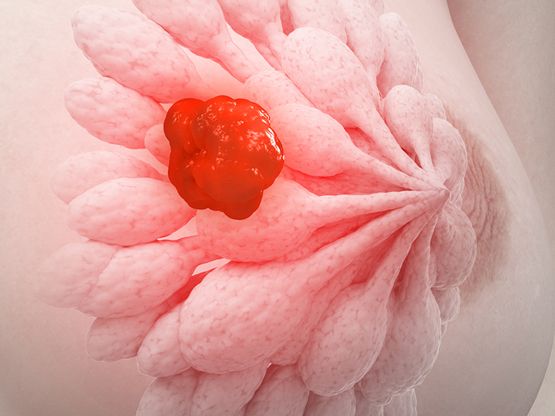 Es gibt mehr als nur eine Brustkrebsart