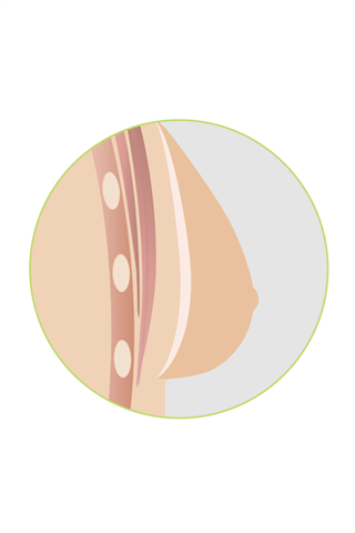 Natura Light 1SN Breast Form Alt 1