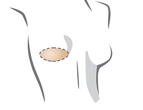 Breast Forms, Breast Prosthesis, Silicone Breast Forms, Prosthesis  Breasts, Mastectomy Prosthesis