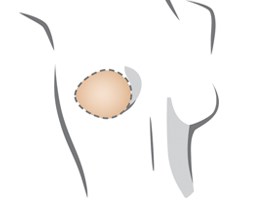 Amoena Lumpectomy Breast Form  Balance Essential Light Volume - GraceMd -  Mastectomy Bras & Breast Forms
