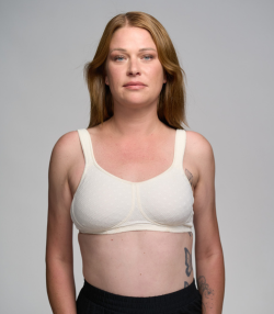 ungleiche Brust, ohne Teilbrustprothese